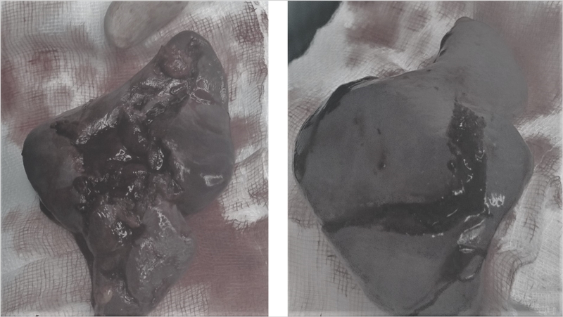 Giải phẫu lách: Cấu tạo, chức năng và các bệnh lý thường gặp 3