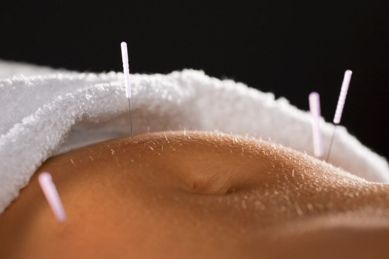 Giảm cân bằng phương pháp cấy chỉ giảm béo, bạn đã từng nghe qua hay chưa?3