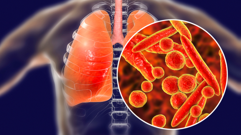 Giảm ho lao một cách hiệu quả - Cách hỗ trợ điều trị đơn giản tại nhà 1