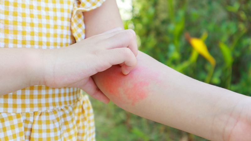 Giảm ngứa da mùa hè hiệu quả với 7 mẹo sau 1