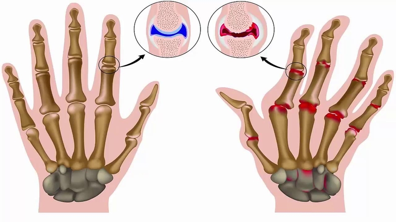 Giảm tiểu cầu miễn dịch có điều trị khỏi được không? 4