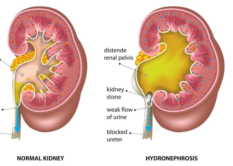Giãn đài bể thận là bệnh gì? Mức độ nguy hiểm của giãn đài bể thận 3