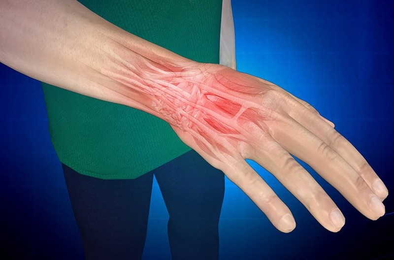 Giãn dây chằng cổ tay là tình trạng các dây chằng bị kéo căng quá mức sau một chấn thương