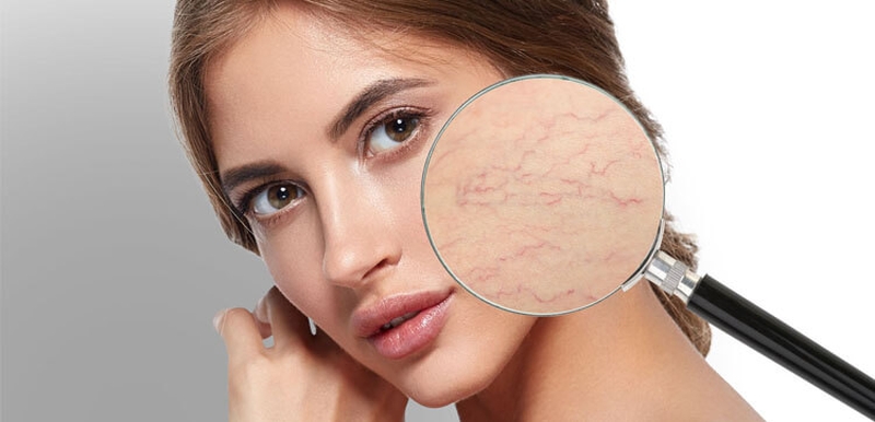 Giãn mao mạch có chữa được không 2