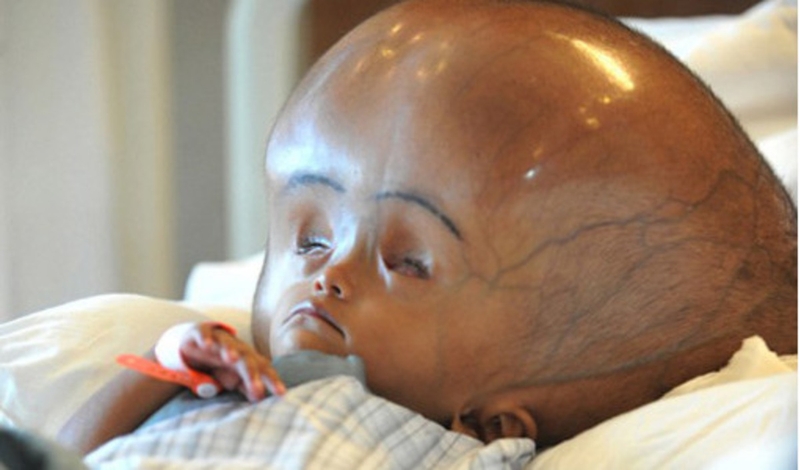 Giãn não thất ở thai nhi là gì? Cần làm gì khi thai nhi bị giãn não thất? 2