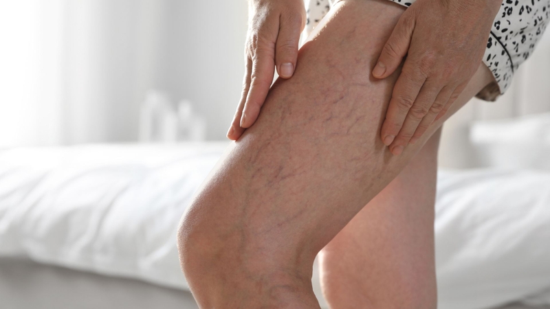 Giãn tĩnh mạch chân là tình trạng mà rất nhiều độc giả phải đối mặt