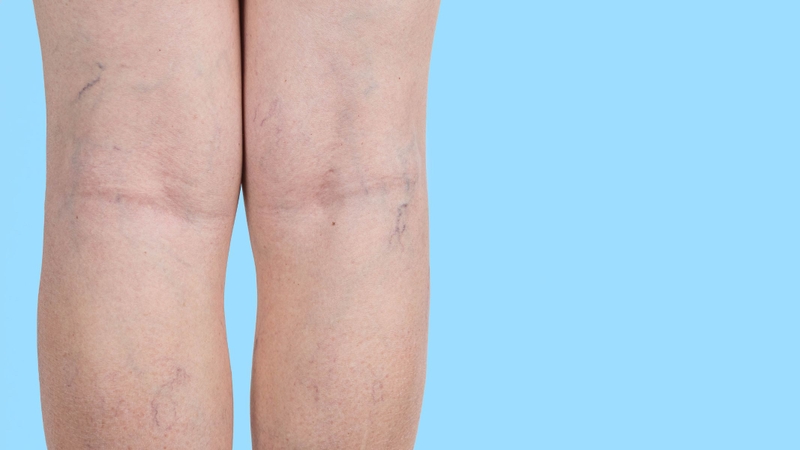 Giãn tĩnh mạch có chạy bộ được không?