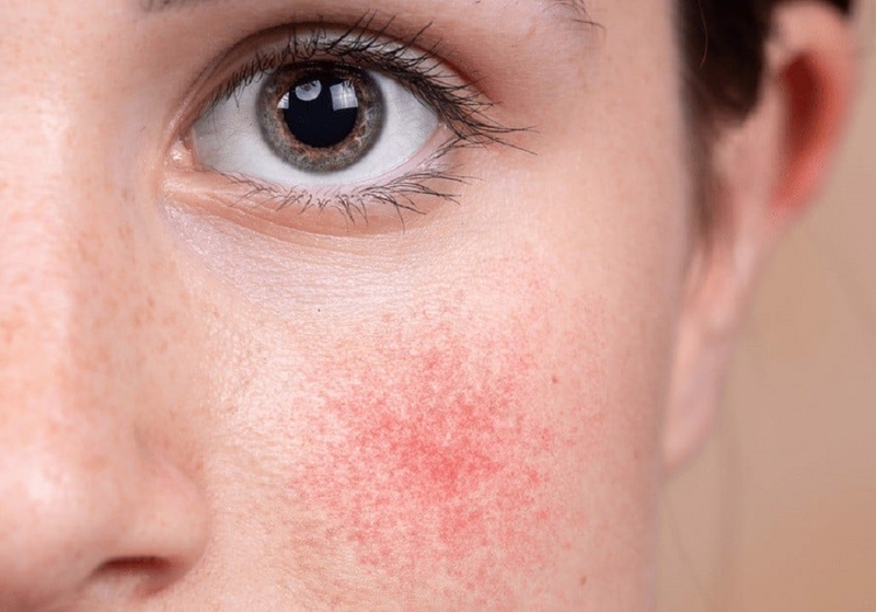 Giãn tĩnh mạch mặt là gì? Nguyên nhân, triệu chứng và cách điều trị 2