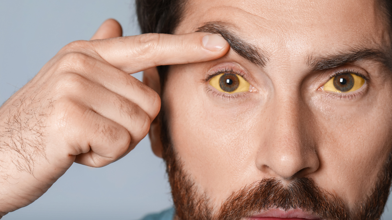 Tình trạng da và lòng trắng của mắt chuyển sang màu vàng