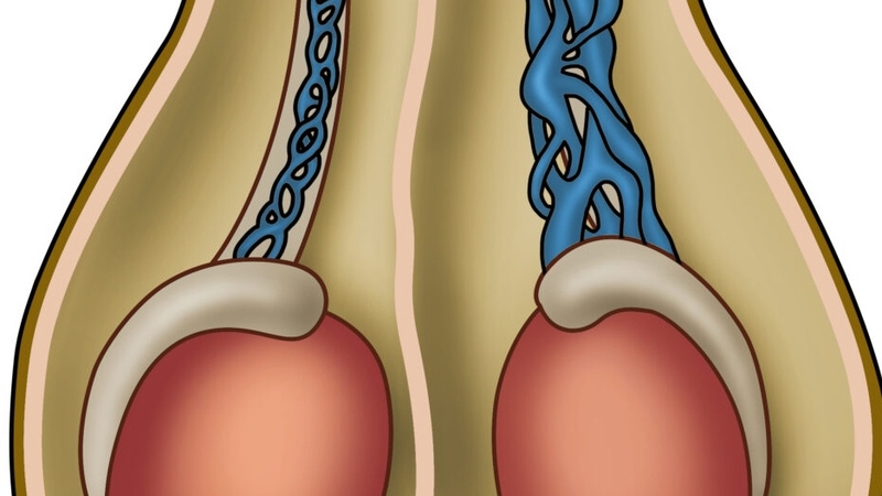 giãn tĩnh mạch thừng tinh 3mm 1