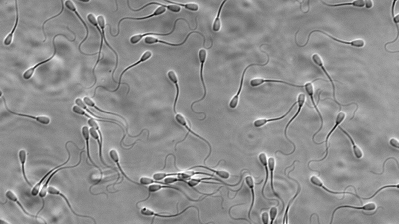 giãn tĩnh mạch thừng tinh 3mm 2