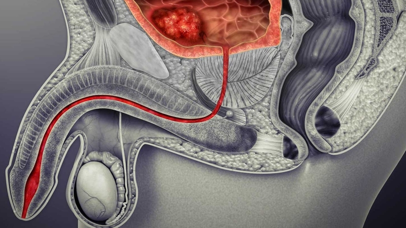 Giãn tĩnh mạch thừng tinh có thể do bất thường giải phẫu hệ tĩnh mạch tinh 1