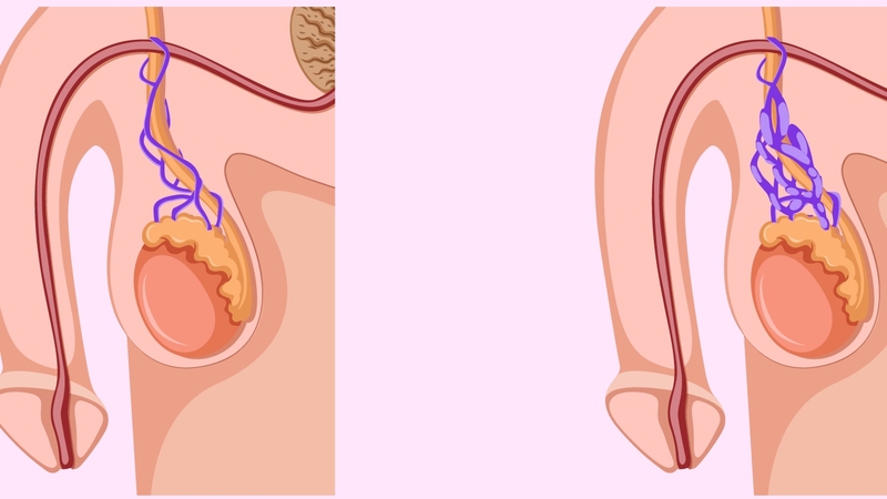 Cơ chế bệnh sinh của giãn tĩnh mạch thừng tinh 2
