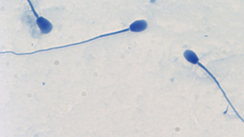 Giãn tĩnh mạch thừng tinh gây thay đổi tinh dịch đồ của nam giới 4