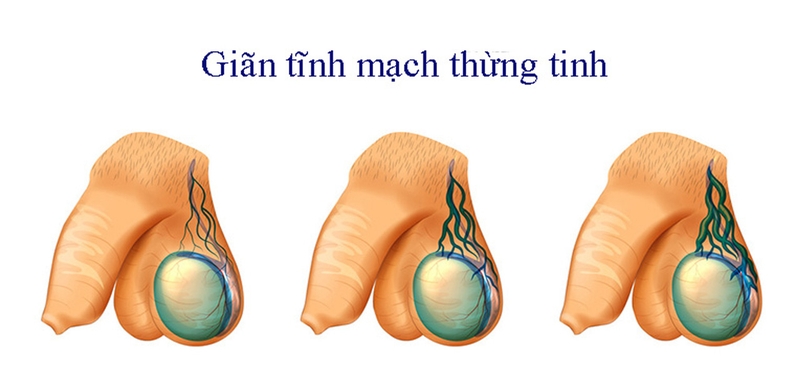 Giãn tĩnh mạch thừng tinh có quan hệ được không? 1