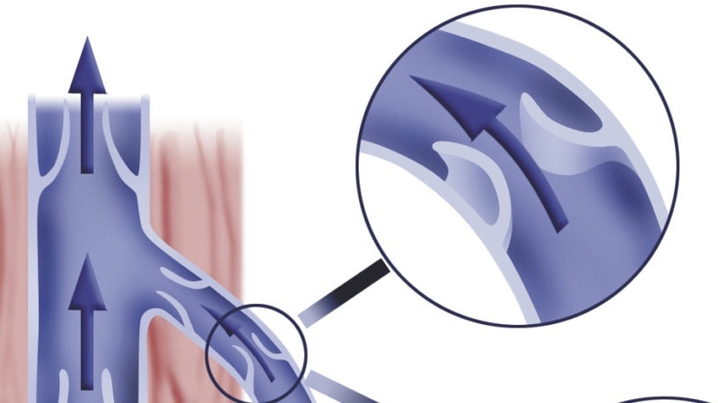 Cơ chế bệnh sinh của giãn tĩnh mạch thừng tinh 2