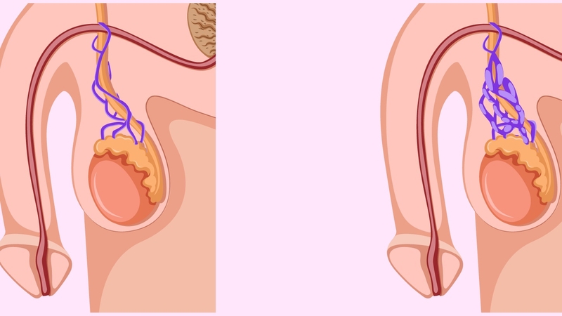Giãn tĩnh mạch thừng tinh có mấy cấp độ? 3