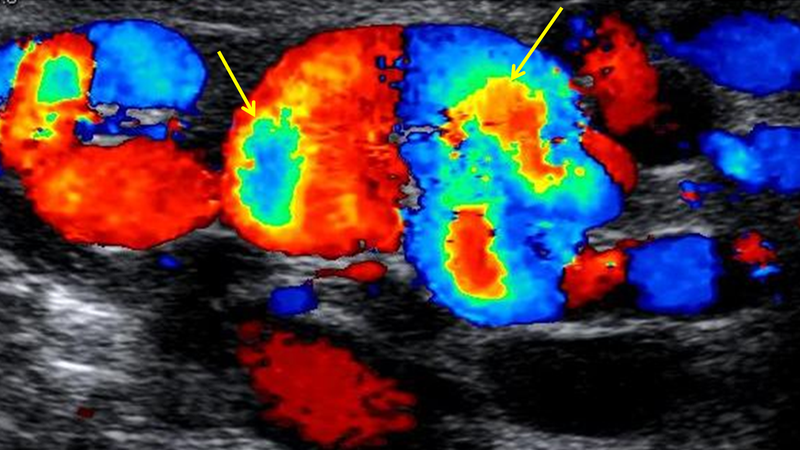 Hình ảnh siêu âm Doppler màu trong giãn tĩnh mạch thừng tinh 5