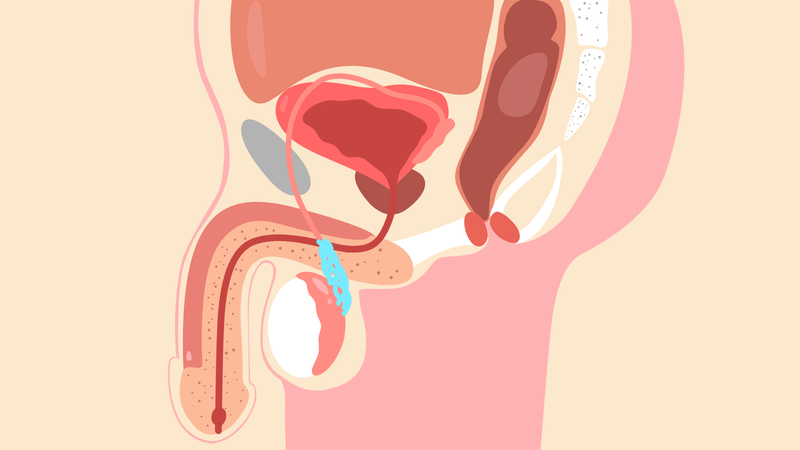 Giãn tĩnh mạch thừng tinh có tự khỏi không?