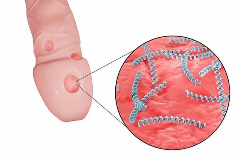 Giang mai dương vật: Triệu chứng, chẩn đoán, điều trị và các biện pháp phòng bệnh 2