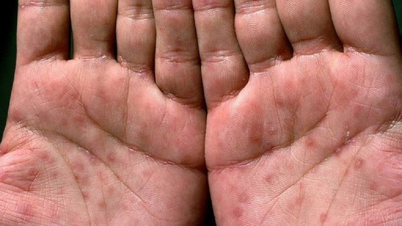 Bệnh vẫn có thể chữa khỏi nếu ở giang mai giai đoạn 1