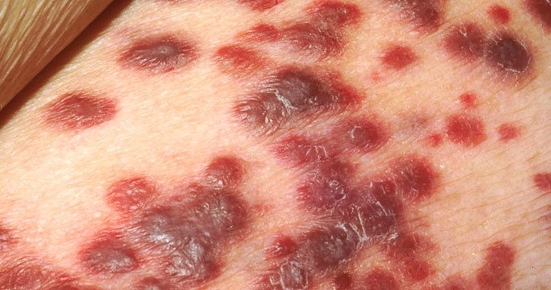 Biểu hiện giang mai giai đoạn 3 là các tổn thương sâu, phá hủy cơ quan nằm trong nguồn năng lượng