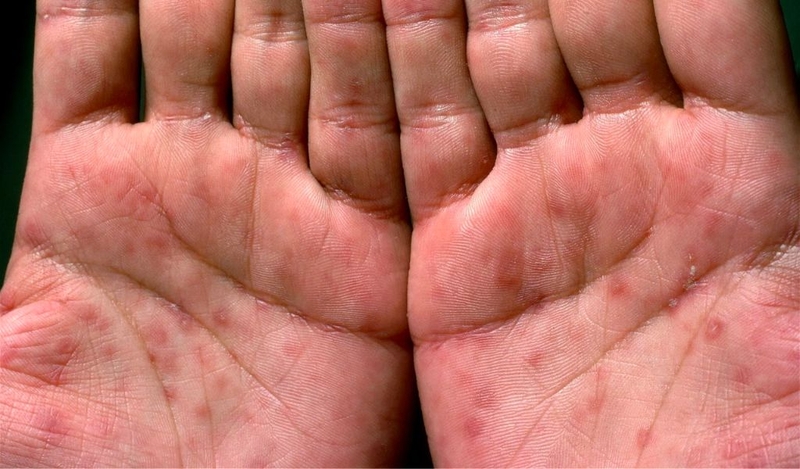 Giang mai kín là gì và các giai đoạn phát triển bệnh? 1