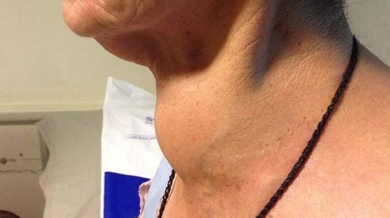 Những vấn đề có thể gặp khi bị bướu cổ ở nam giới 1