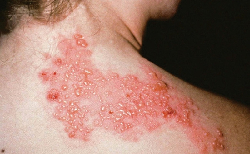 Cách phân biệt viêm da do giời leo và kiến ba khoang cắn 1