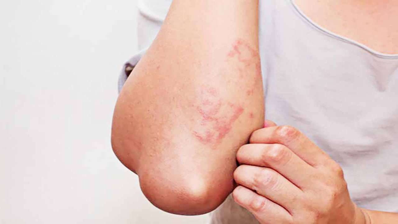 Giun sán là gì? Nguyên nhân, triệu chứng và cách điều trị 4