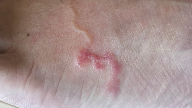 Nhiễm giun tròn: Nguyên nhân, triệu chứng và cách phòng ngừa 1