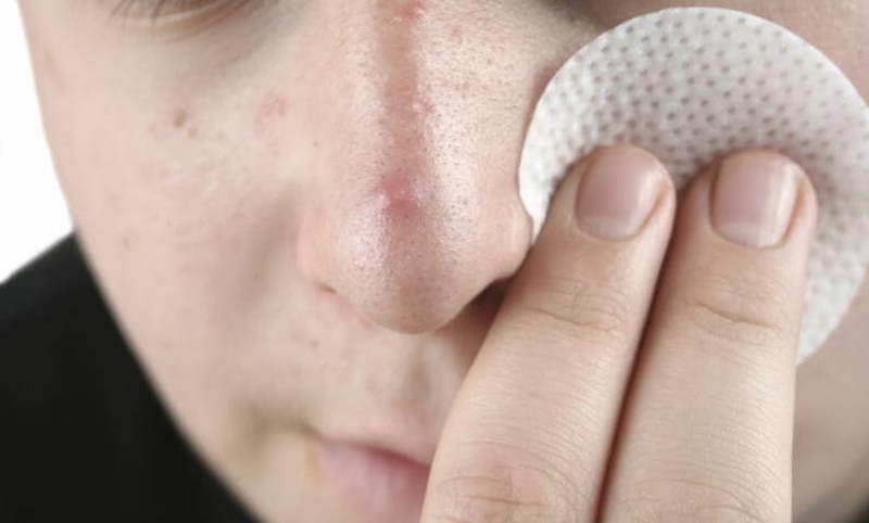 Giúp làn da khỏe đẹp: Làm gì khi mụn bị chai?1