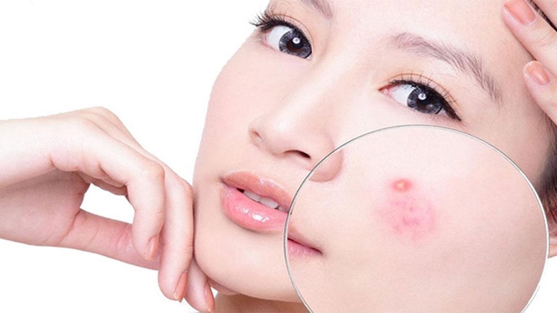 Giúp làn da khỏe đẹp: Làm gì khi mụn bị chai?3