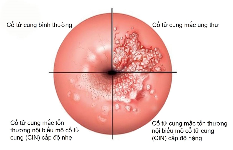 Góc giải đáp: 12 type hpv nguy cơ cao gồm những chủng nào và gây ra bệnh lý gì? 1