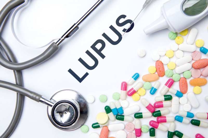 Góc giải đáp: Bệnh lupus ban đỏ hệ thống có chữa được không? 1