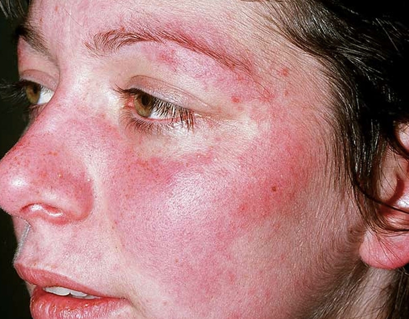[GÓC GIẢI ĐÁP] Bệnh lupus ban đỏ hệ thống lây không? 1