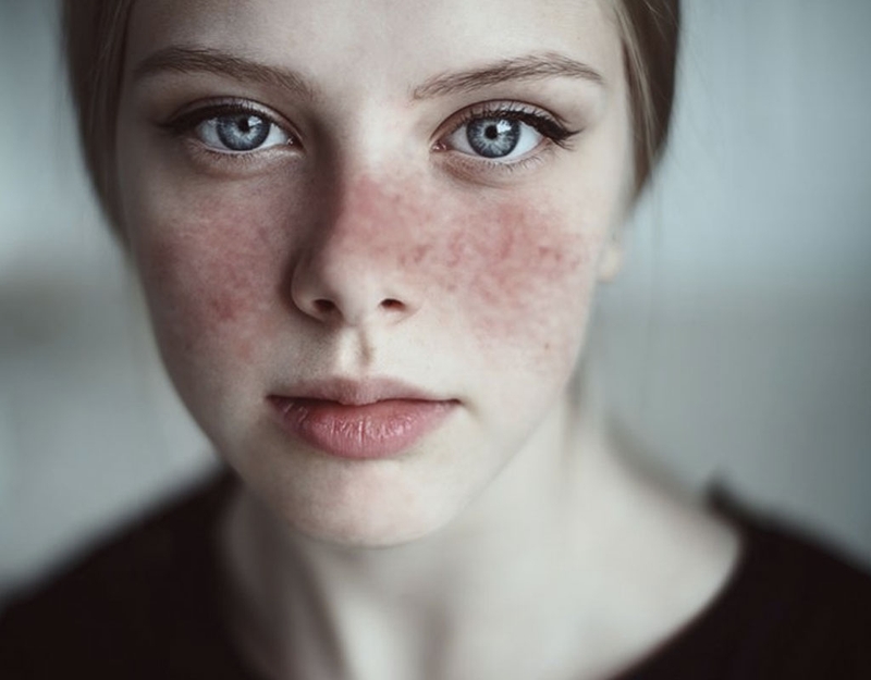 [GÓC GIẢI ĐÁP] Bệnh lupus ban đỏ hệ thống lây không? 2