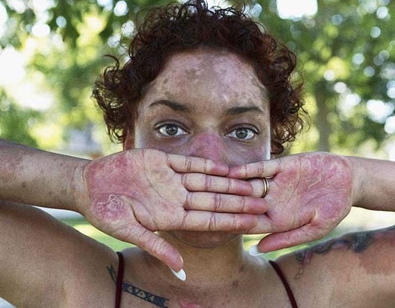 [GÓC GIẢI ĐÁP] Bệnh lupus ban đỏ hệ thống lây không? 3