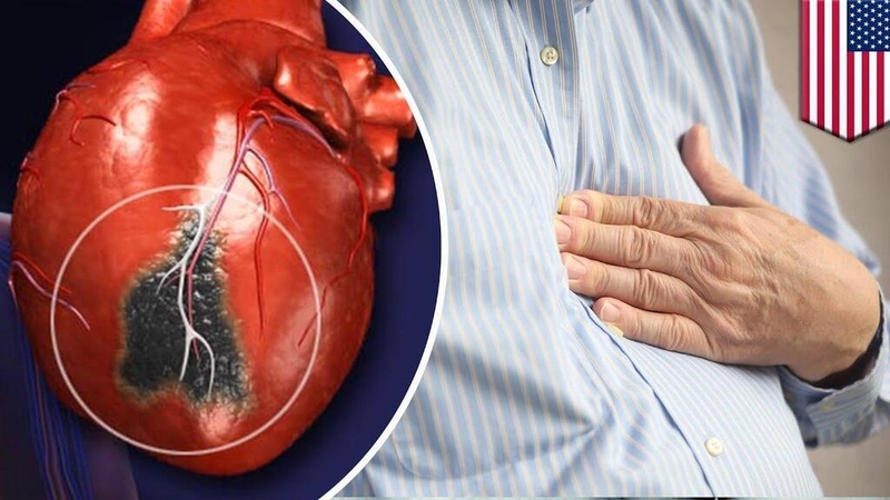 Góc giải đáp thắc mắc: Bệnh nhồi máu cơ tim có nguy hiểm không? 4