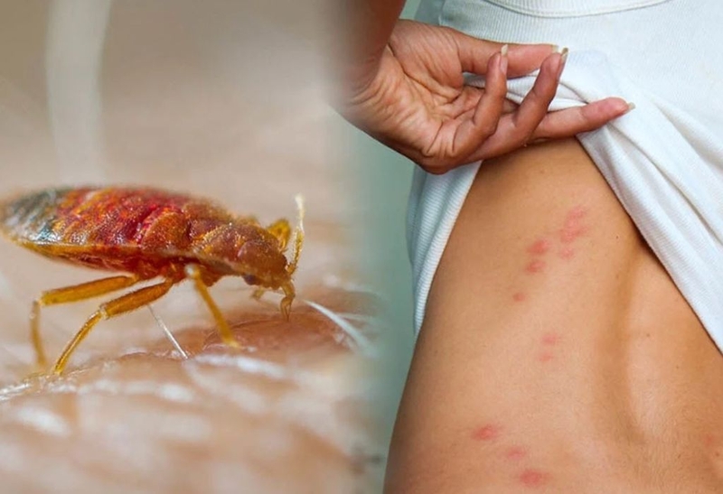 Góc giải đáp: Bị rệp giường cắn bôi thuốc gì? 1