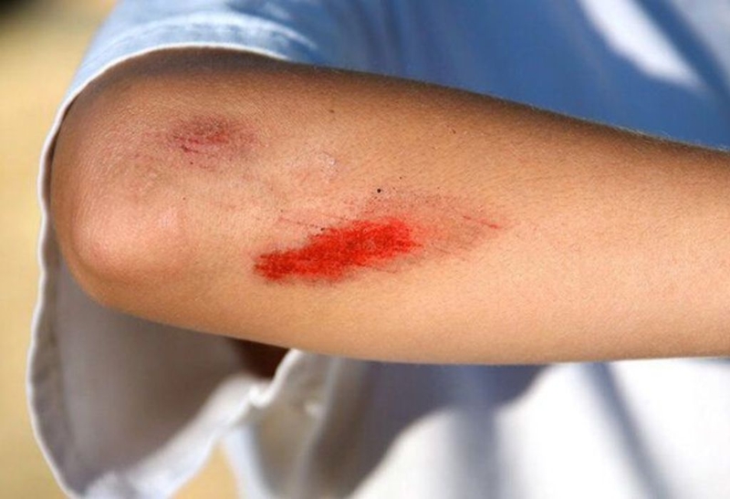 Góc giải đáp: Bị vết thương hở có ăn xoài được không? 1