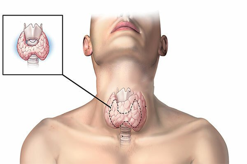 Góc giải đáp: Bướu cổ khám ở đâu uy tín và hiệu quả 1
