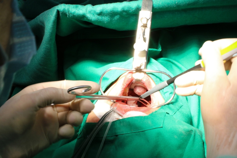 Góc giải đáp: Cắt amidan bao lâu thì nói được? 1