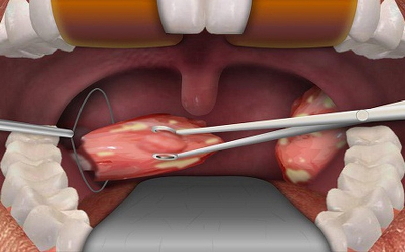 Góc giải đáp: Cắt amidan bao lâu thì nói được? 2