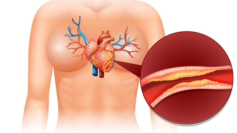 goc-giai-dap-chi-phi-dat-stent-tim-la-bao-nhieu 2