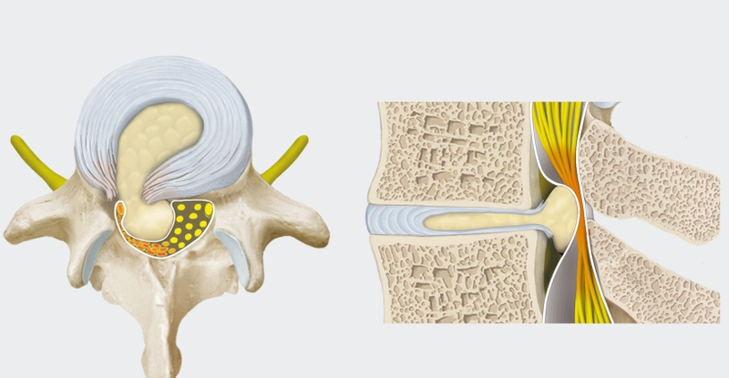 Góc giải đáp: Chụp X quang có phát hiện thoát vị đĩa đệm? 1