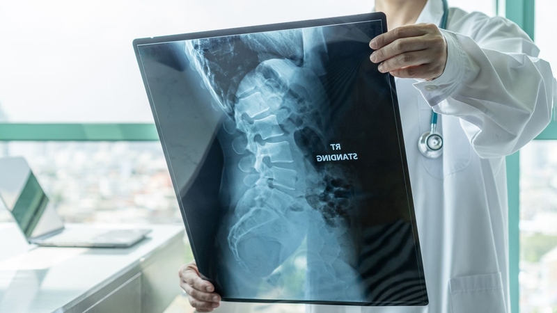 Góc giải đáp: Chụp X quang có phát hiện thoát vị đĩa đệm? 2