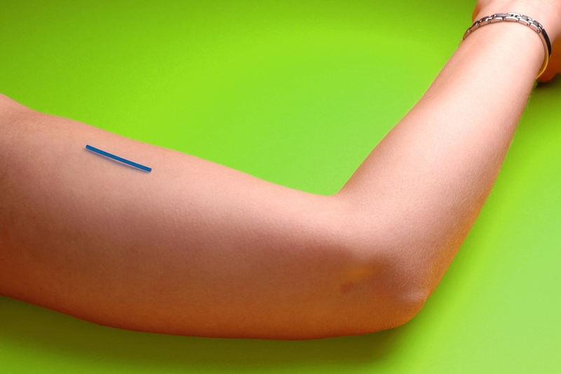 Góc giải đáp: Có phương pháp cấy que tránh thai cho đàn ông không?  2