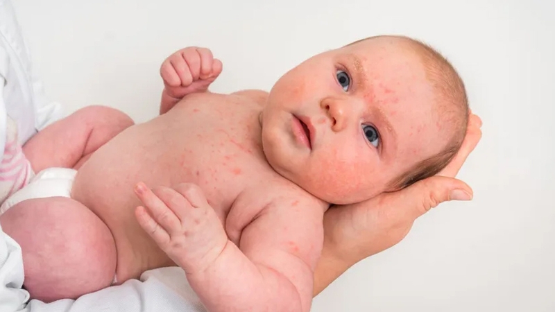 Góc giải đáp: Da trẻ sơ sinh nổi vân hoa có nguy hiểm không? 1
