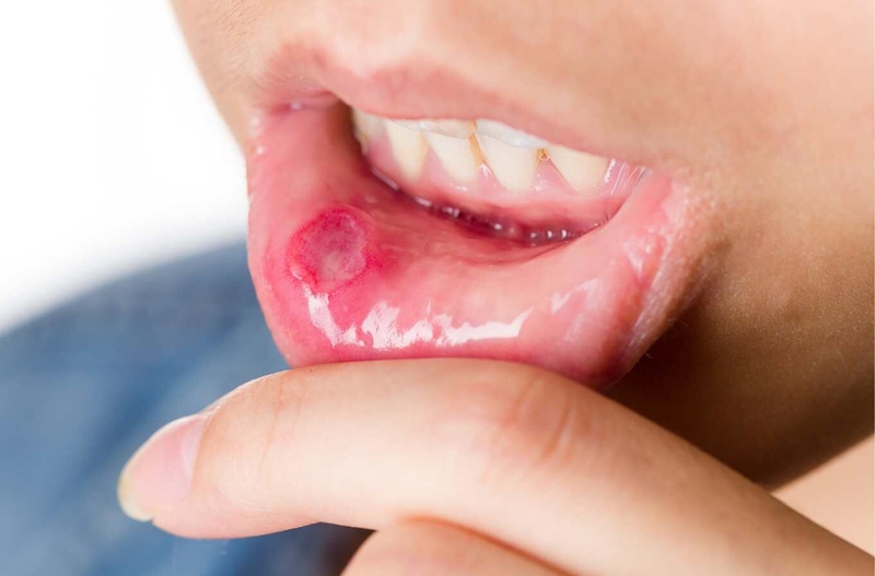 Góc giải đáp: Daktarin Oral Gel có trị nhiệt miệng không? 1